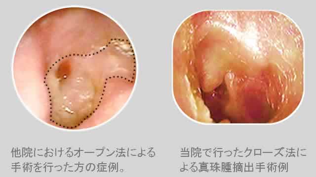 真珠腫の手術　外耳道後壁保存法